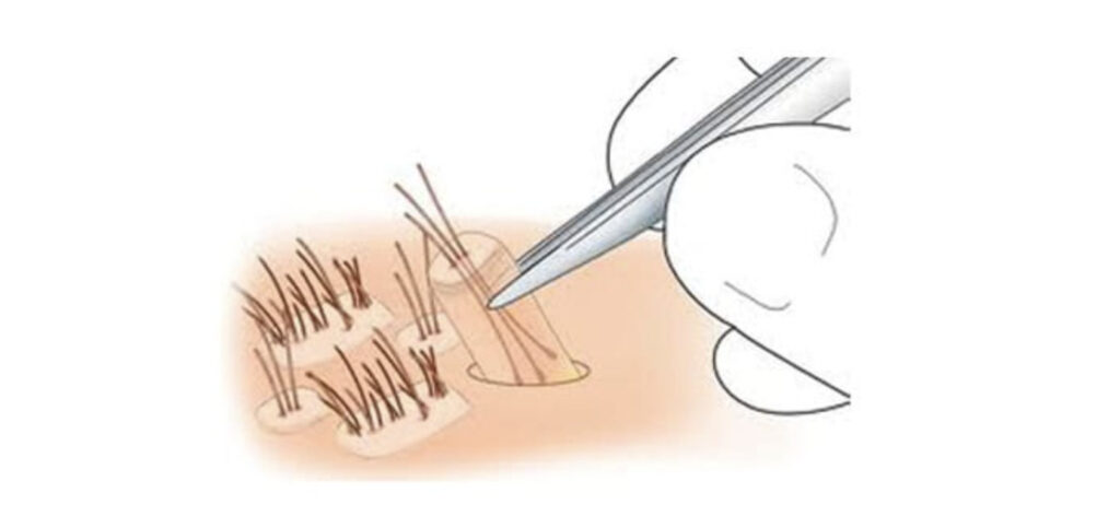 Medical tool performing hair follicle extraction during hair transplant.
