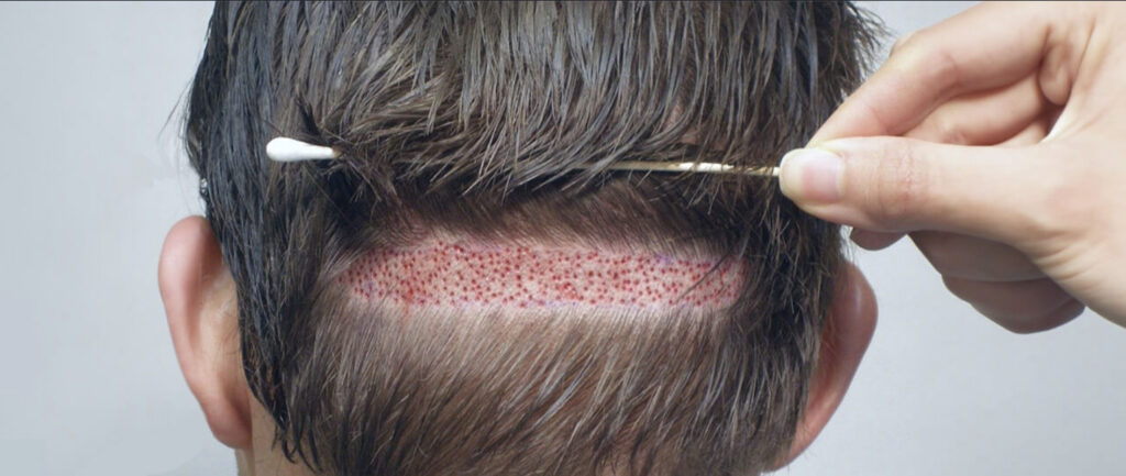 Close-up of FUE hair transplant with micro-incisions on scalp.