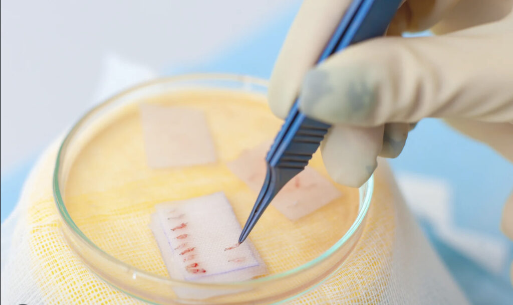 Close-up of hair follicle transplant process in a clinical setting.