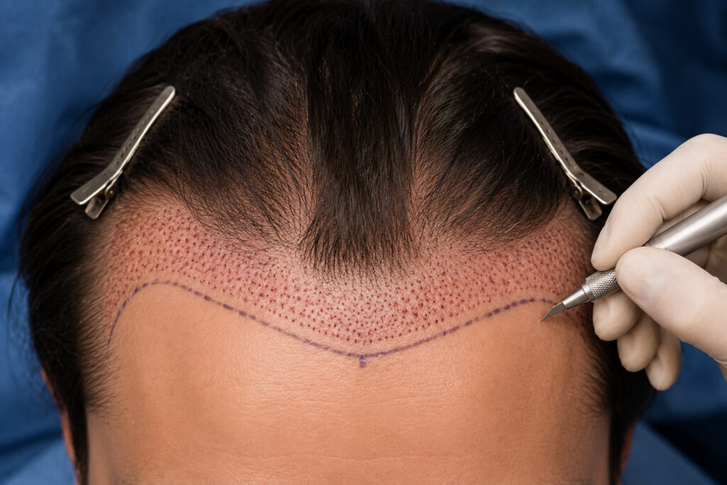 Female hair transplant surgery with scalp marking and surgical tools.