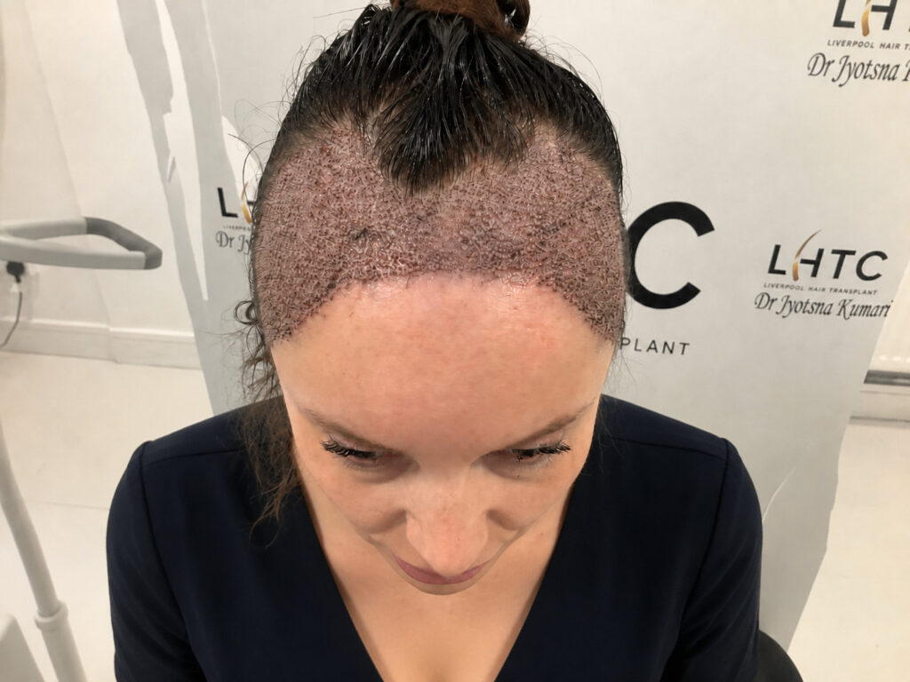 Woman with freshly transplanted hair at the hair clinic in Liverpool.