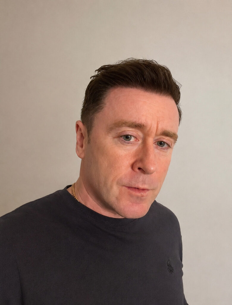 Male patient with improved hair density post FUT hair transplant in Liverpool.