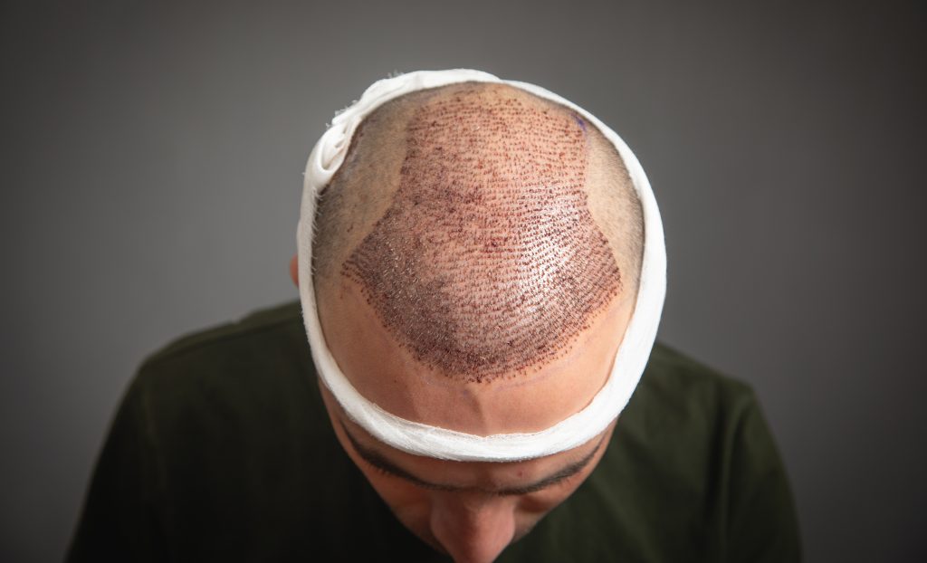 Patient's scalp after hair transplant with visible grafts and bandage.