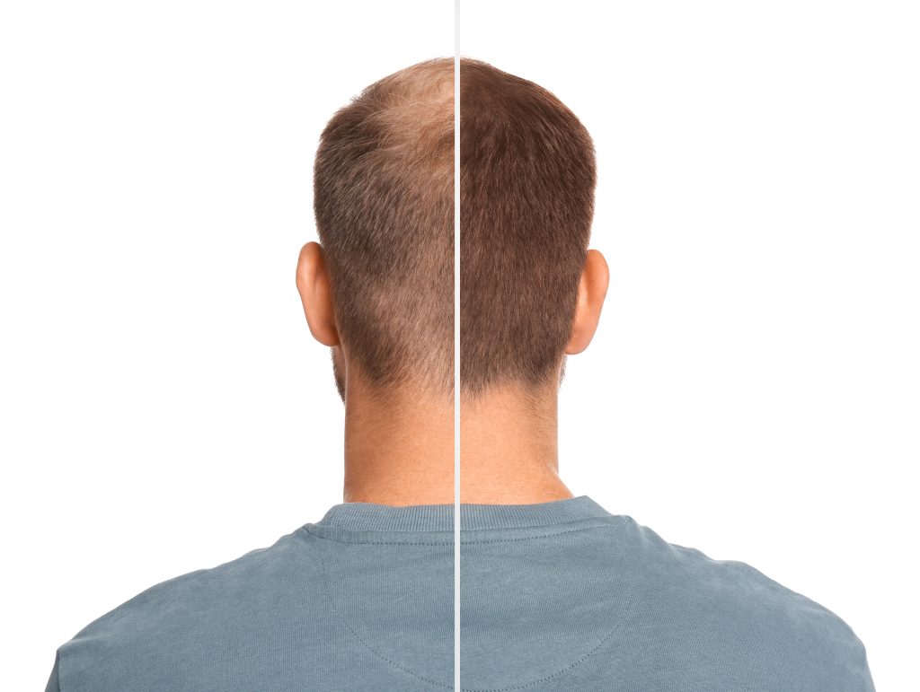 Before and after hair restoration treatment on the back of a man's head.