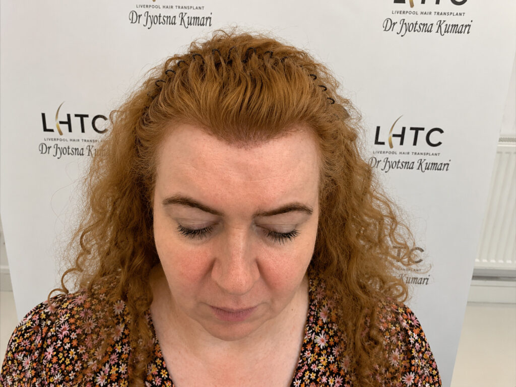 Woman with red curly hair after hair transplant treatment at The Skin and Hair Clinic.