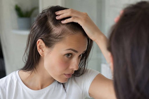 Women Receding Hairline
